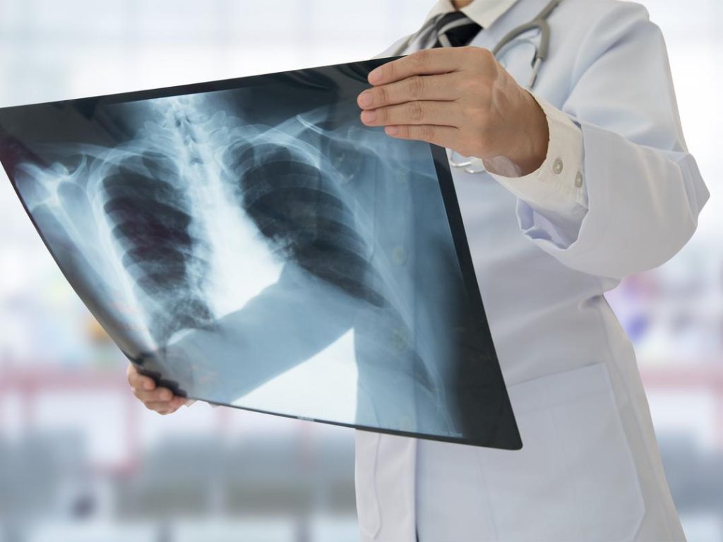 الطيب حمضي: داء السل سريع الانتشار وينتقل من الحيوان إلى الإنسان