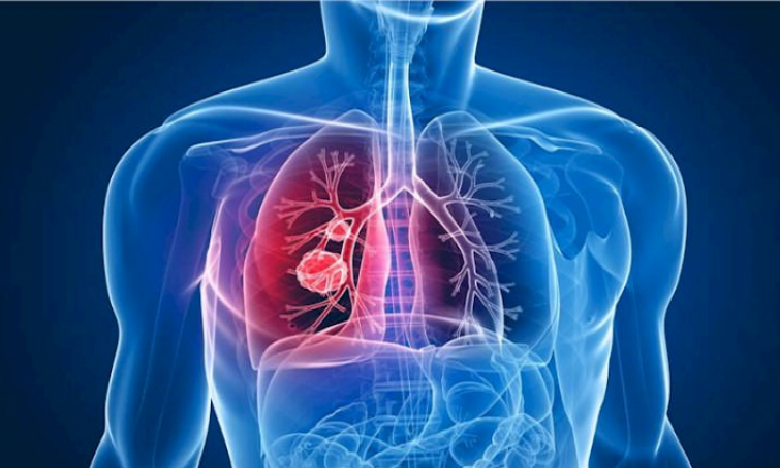 المجتمع المدني يشدد على دحر داء السل وإنهائه المغرب