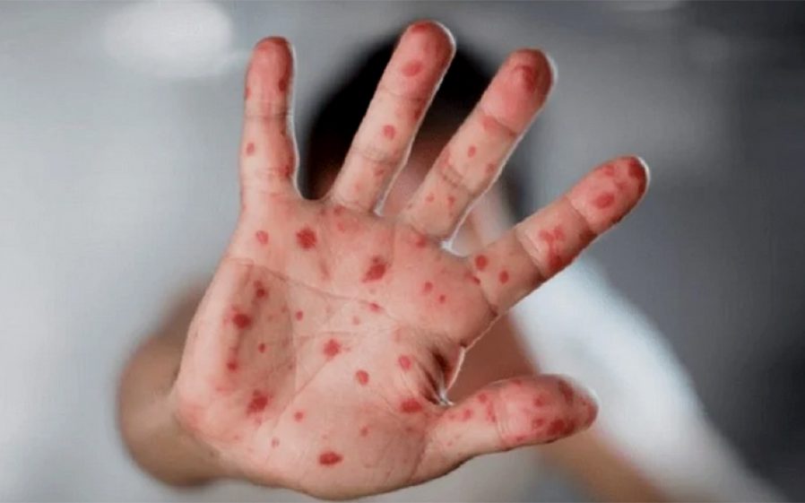 حمضي: فعالية المنظومة الصحية ساهمت في الكشف عن أول حالة إصابة بجدري القردة