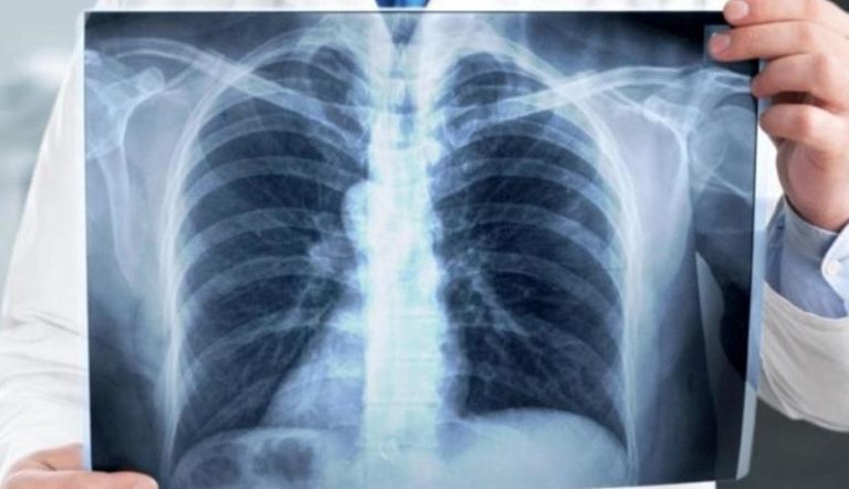 اليوم العالمي لمحاربة السل... وزارة الصحة تطلق الحملة الوطنية للكشف عن هذا الداء