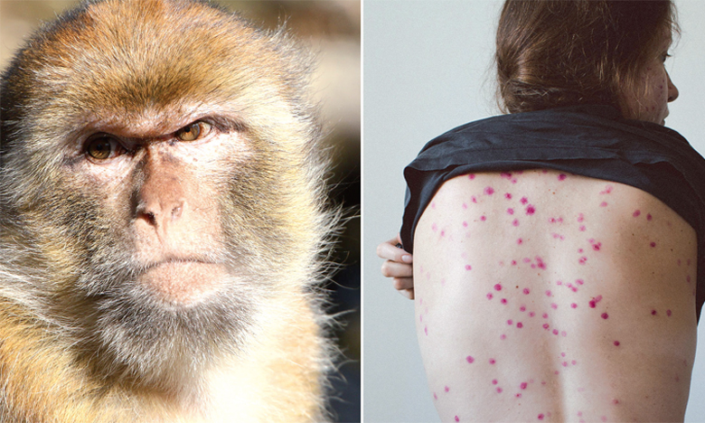 جدري القردة.. مواطنون يدعون إلى الاعتماد على الأخبار الموثوقة والالتزام بالنظافة الشخصية