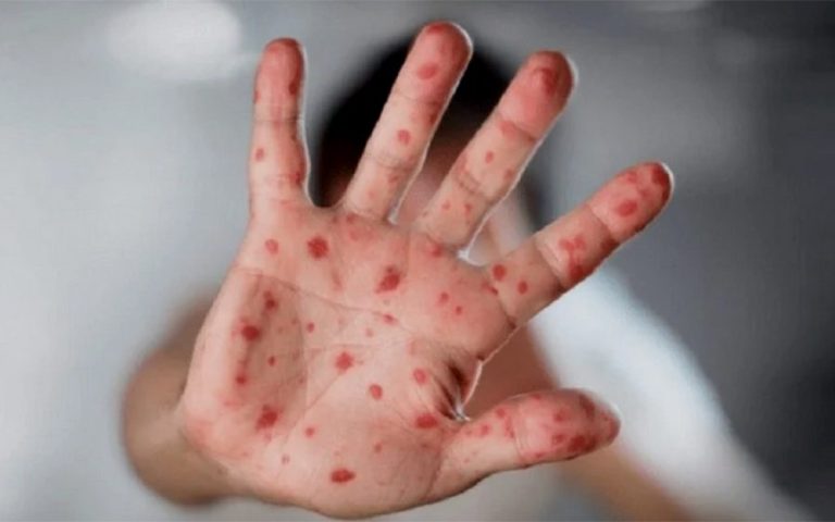 حمضي: فعالية المنظومة الصحية ساهمت في الكشف عن أول حالة إصابة بجدري القردة