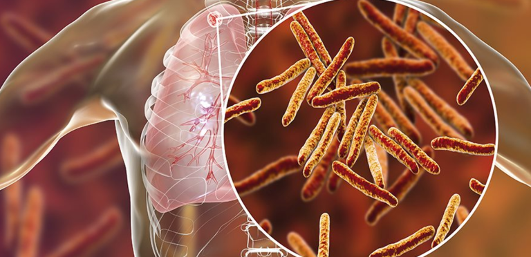 وزارة الصحة تنظم لقاءا وطنيا حول مرض السل وتطلق مشروع "التكوين المستمر عن بعد"