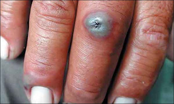 الجمرة الخبيثة تستأثر باهتمام مسؤولي الصحة في المغرب