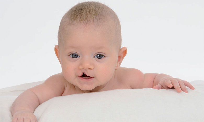 طنجة: جمعية "عملية بسمة" تطلق عمليات تصحيح تشوهات الشفتين