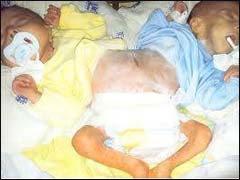 المعطيات العلمية تحول دون فصل توأم سيامي مغربي المعطيات العلمية تحول دون فصل توأم سيامي مغربي