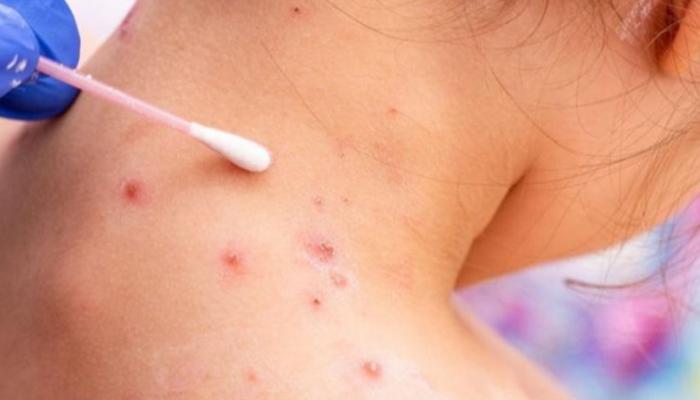 عزل 15 تلميذ بمنازلهم بعد إصابتهم بفيروس "بوشويكة" بقلعة السراغنة