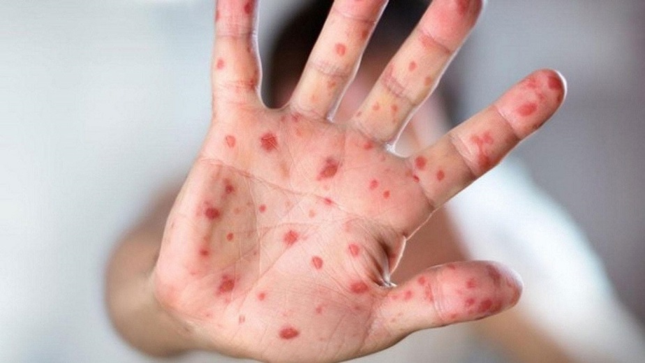 جدري القردة.. المغرب لم يسجل أي حالة إصابة بمرض جدري القردة منذ شهور جدري القردة.. المغرب لم يسجل أي حالة إصابة بمرض جدري القردة منذ شهور