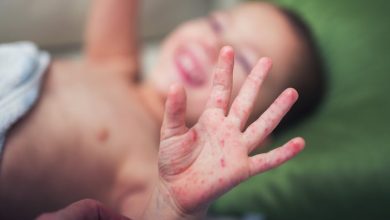 الأندلس تسجل ارتفاعاً في داء الحصبة
