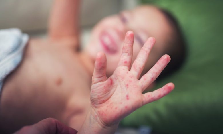 الأندلس تسجل ارتفاعاً في داء الحصبة الأندلس تسجل ارتفاعاً في داء الحصبة